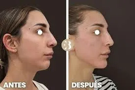 Eliminar papada en Valencia: ciencia, textura y biorevitalización